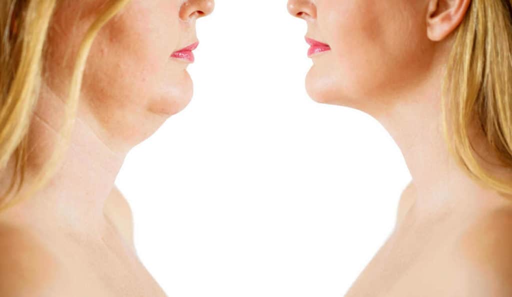 Double Chin treatment Keighley before and after results