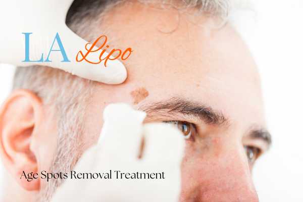 What Are the Most Effective Treatments for Age Spots Keighley?