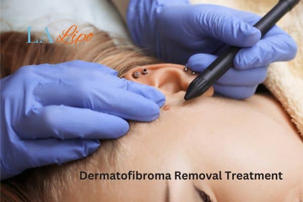 Dermatofibroma Removal Treatment Keighley
