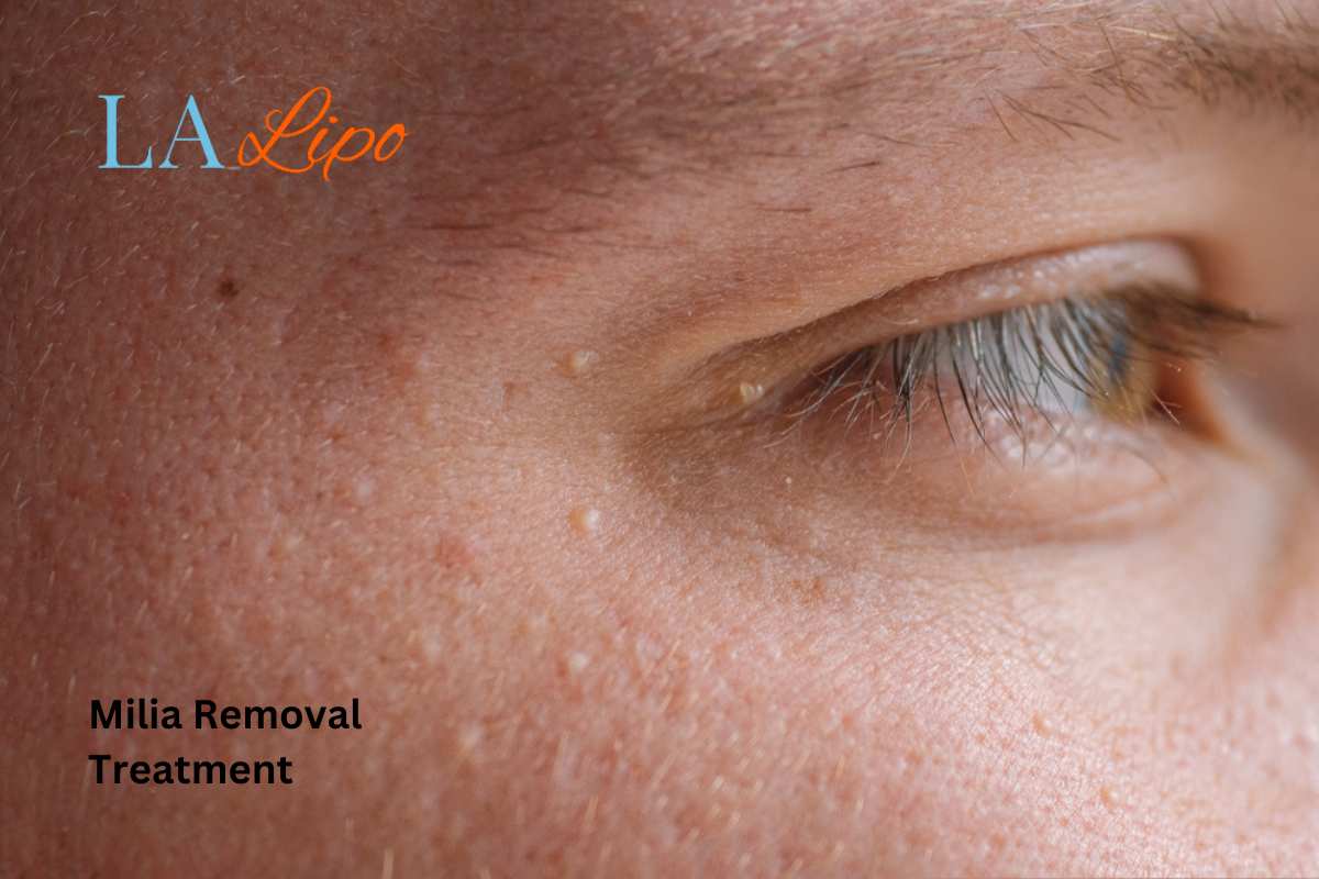Cryopen Milia Removal: Is It the Easiest and Safest Option Keighley?