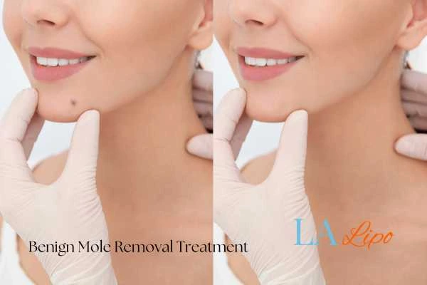 woman's before and after mole removal Keighley results
