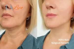 hi-fu for wrinkles Keighley before and after results