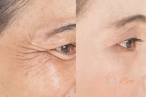 Before and after results of woman - HI-fu wrinkles reduction treatment Keighley
