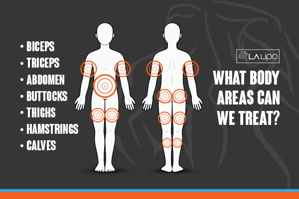 Graphic to show areas you can have LA-EMS Body Sculpting Keighley treatment.