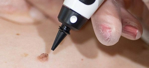 skin tag removal using cryopen Keighley