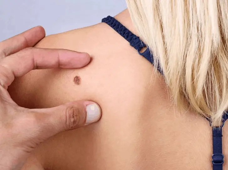 woman having mole removal Keighley consultation before treatment.