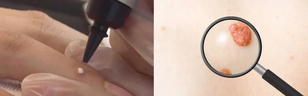 Cryopen for mole removal Keighley - speak to our team today!