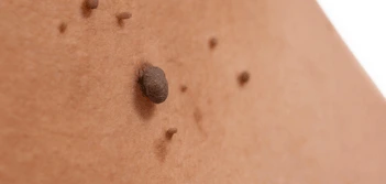 image of a skin tag Keighley