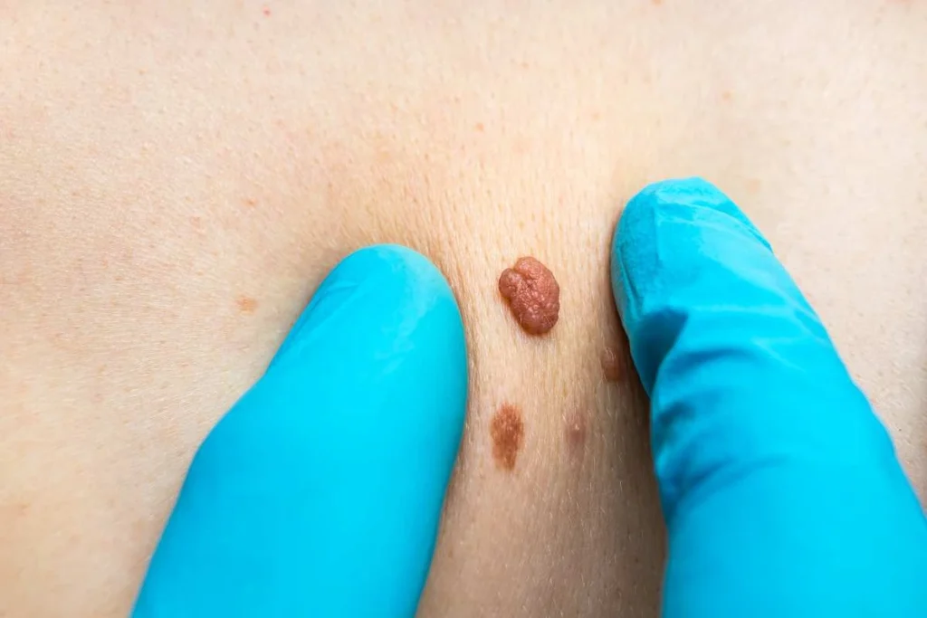 Consultant examining a skin tag Keighley
