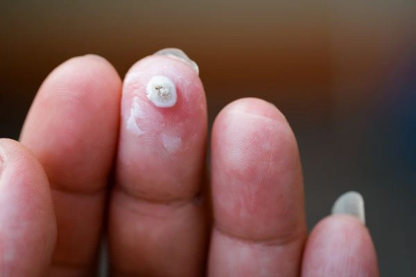 wart on person finger - cryotherapy to treat from LA LIPO Keighley