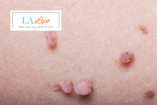 Does cryopen skin tag removal Keighley hurt? Find out now call our team today!