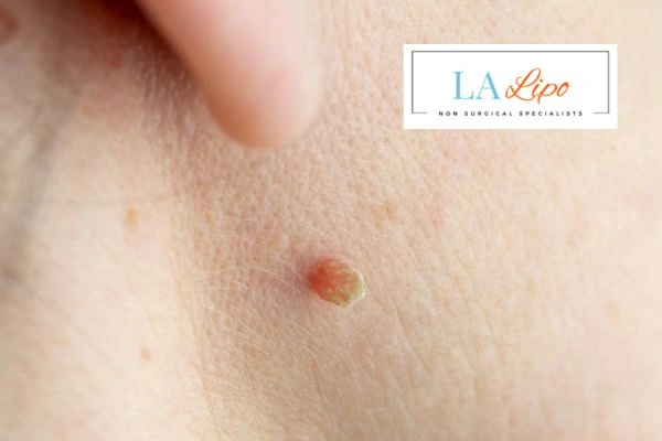 Book skin tag removal Keighley today speak to our team now!