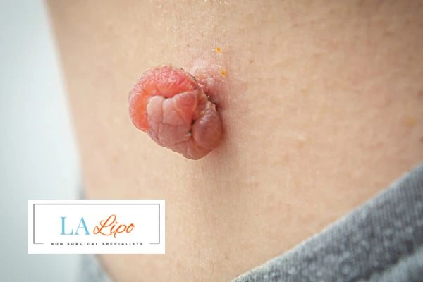 Interested in skin tag removal Keighley? Concerned about the pain? Find out more today!
