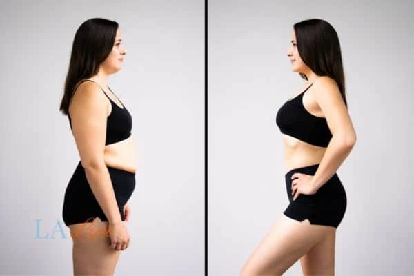 Picture of womans before and after using LA-EMS body sculpting to improve her core strength Keighley