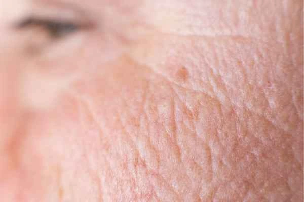 close up picture of a woman's face showing an age spot Keighley