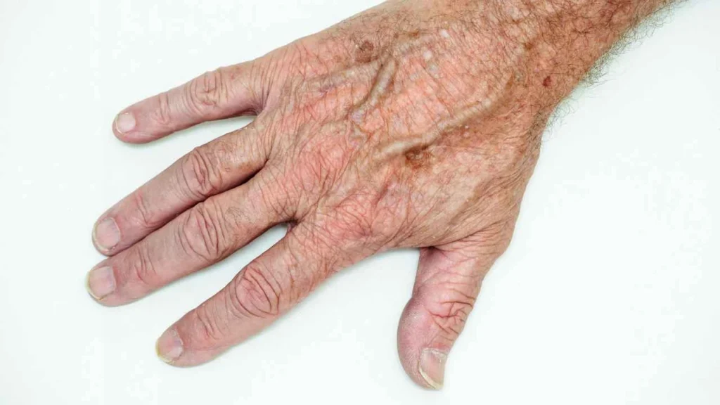 Male hand showing age spot Keighley