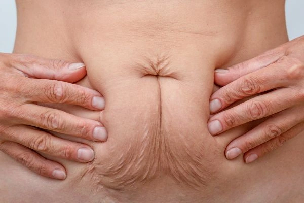 Should I Combine Diastasis Recti Treatment with Body Contouring for Better Results Keighley?