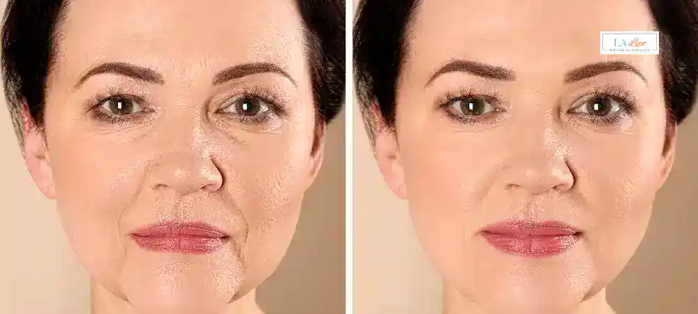 How Long Does It Take to See Results and How Long Do They Last Keighley?